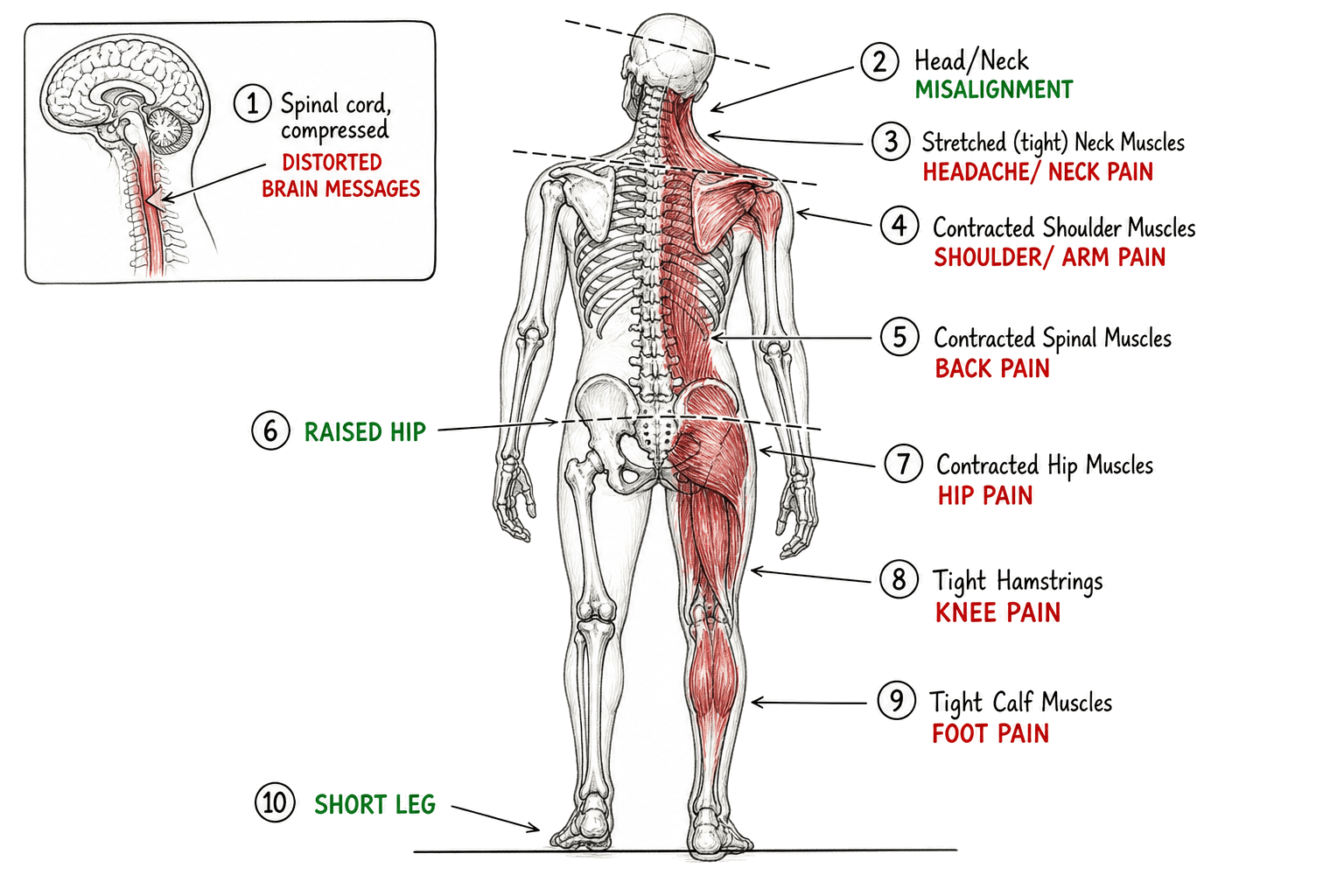 Diagram showing how a problem in one part of the spine can lead to pain in the neck, shoulders, back, hips, and legs
