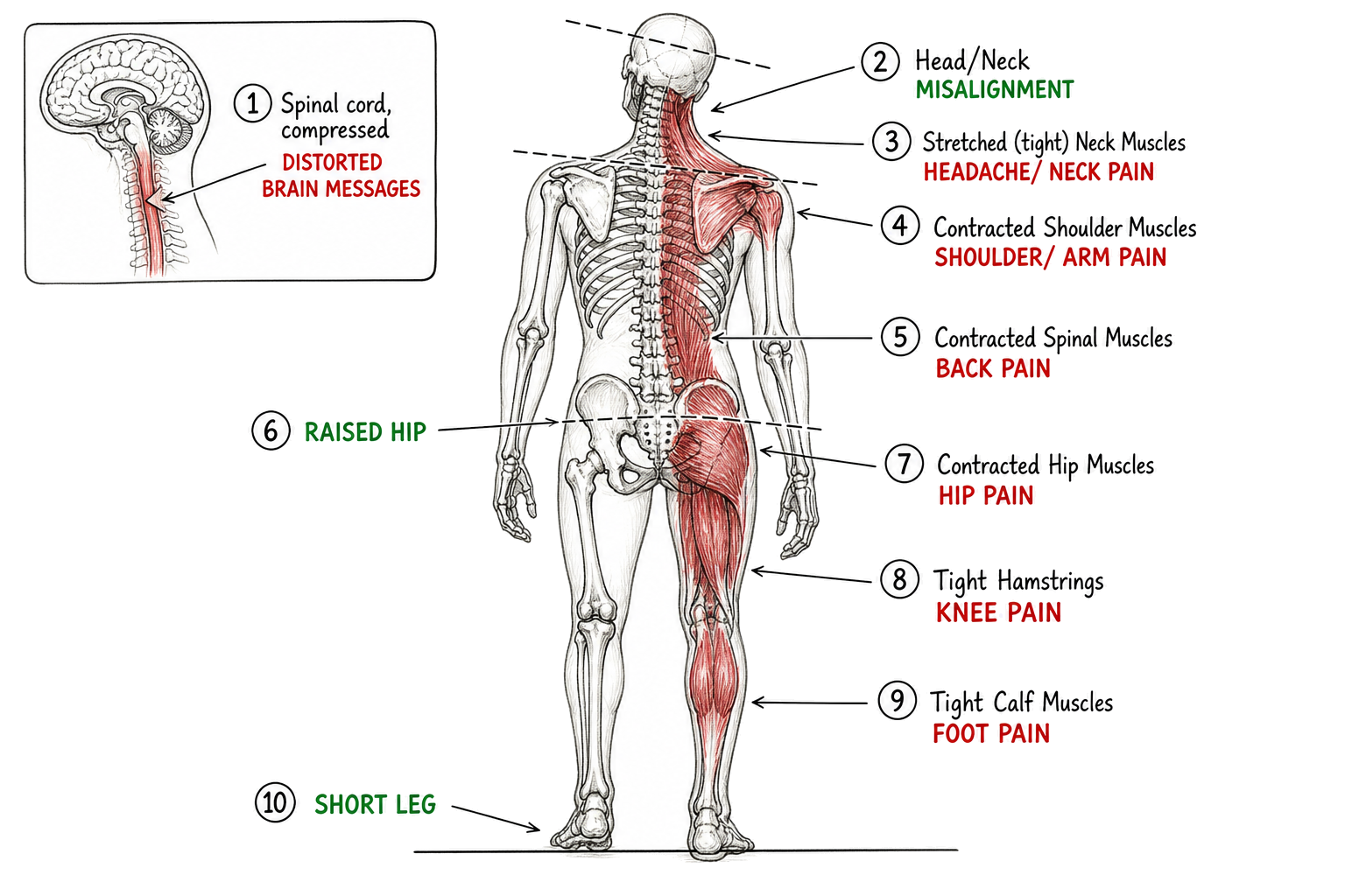 Diagram showing how a problem in one part of the spine can lead to pain in the neck, shoulders, back, hips, and legs
